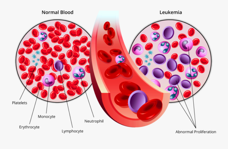 fucoidan-effect-and-acute-myelogenous-leukemia-cancer-and-fucoidan